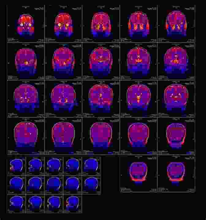 A Functional Magnetic Resonance Imaging (fMRI) Scan Showing Brain Activity During Hallucinations Hallucinations: The Science Of Idiosyncratic Perception