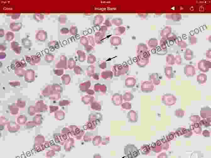 A Microscope Image Of Red Blood Cells Affected By G6PD Deficiency The Truth About Living With G6PD Deficiency