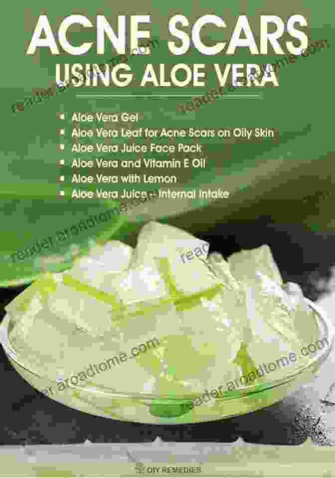 Aloe Vera, A Calming Natural Remedy For Acne. Acne Solution: Get Rid Of Acne With Simple Natural Remedies