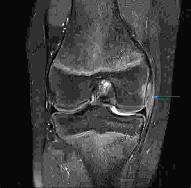 Detailed MRI Image Of A Knee Joint, Showcasing Intricate Structures And Tissues Magnetic Resonance Imaging And Spectroscopy In Sports Medicine