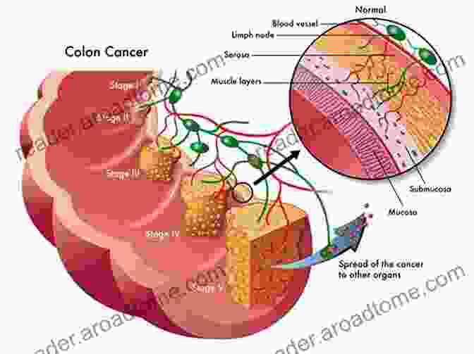 Diagram Of Colorectal Cancer Colorectal Cancer (Recent Results In Cancer Research 83)