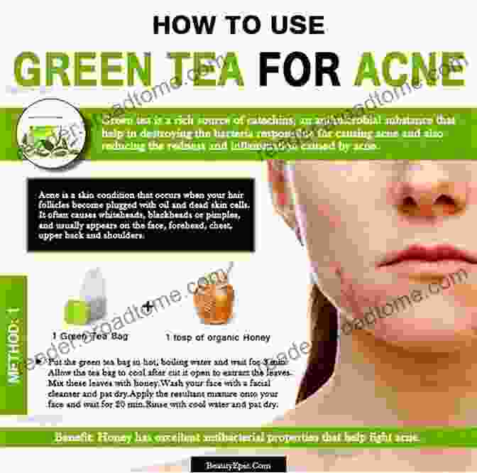 Green Tea, A Natural Remedy For Acne With Antioxidant And Anti Inflammatory Properties. Acne Solution: Get Rid Of Acne With Simple Natural Remedies