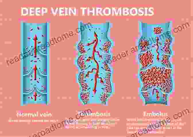 Thrombosis Chart Quick Reference Guide Book Image Thrombosis E Chart: Quick Reference Guide