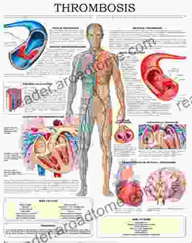 Thrombosis e chart: Quick reference guide