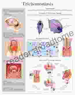 Trichomoniasis E Chart: Full Illustrated